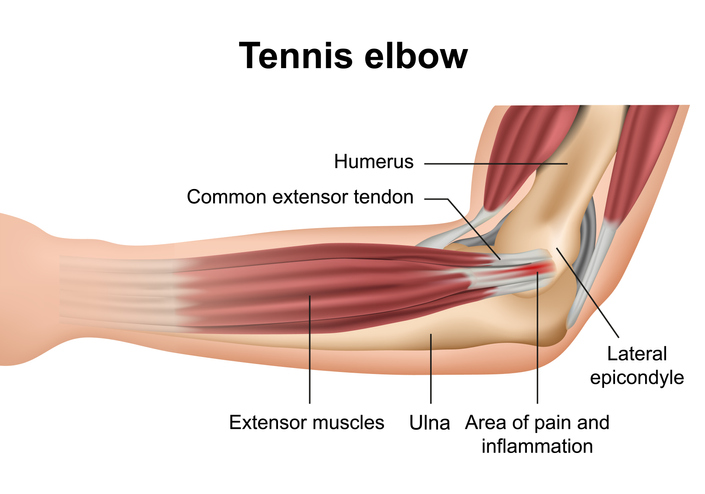 diagram of the elbow and forearm showing the area where tennis elbow pain occurs